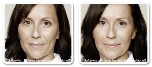 Raffermir la peau du visage à l'acide hyaluronique à Nice | Clinique des Champs-Elysées