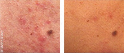 Traitement de l’acné