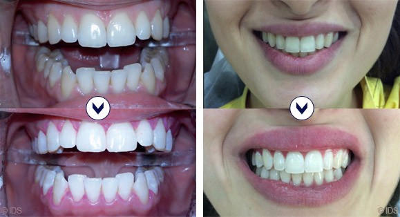 Blanchiment des dents avec BlancOne® (photoactivation)