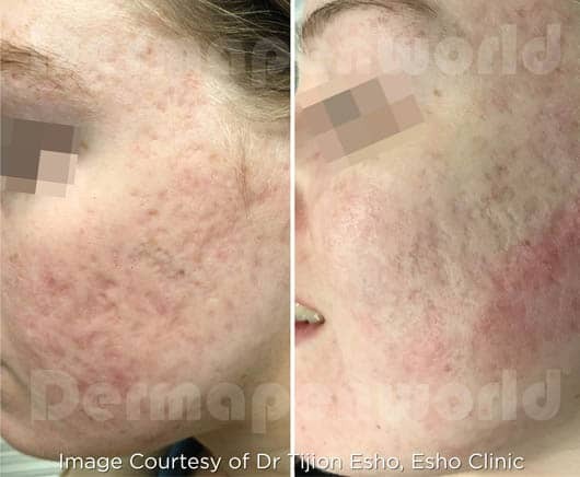 DermaPen : Effacer les cicatrices d'acné