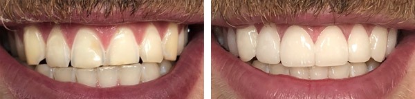 Correction d’une supraclusion dentaire