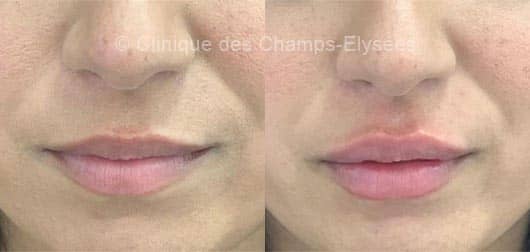 Russian Lips : Repulper les lèvres