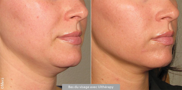 Raffermissement de l’ovale du visage avec Ulthera®