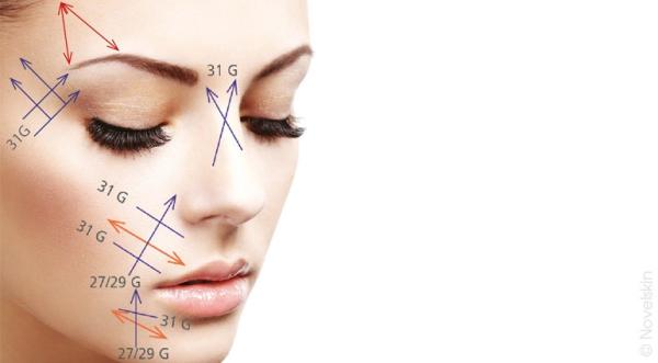 Les différents positionnements des fils tenseurs sur le visage et le corps