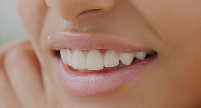 L’alignement de vos dents vous permet de retrouvez un un charmant sourire | Clinique des Champs-Elysées