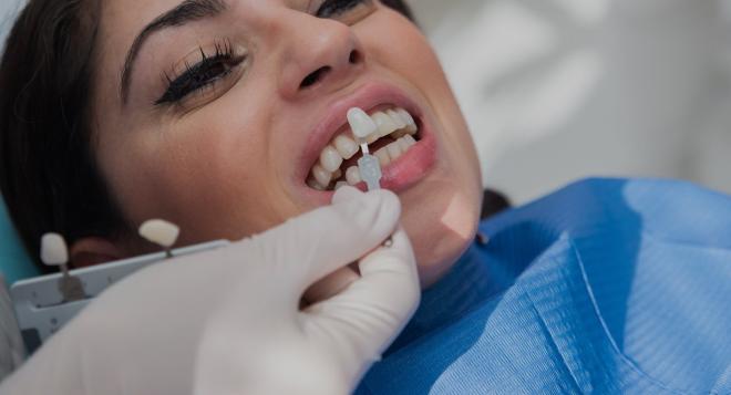 Les techniques pour blanchir ses dents pour avoir un sourire plus éclatant à Nice | Clinique des Champs-Elysées
